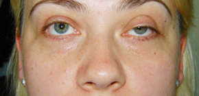 Was tun, wenn die Augenlider nach Botox sinken?