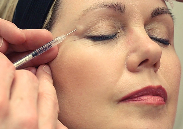 Une injection de Botox pour éliminer les rides du contour des yeux.