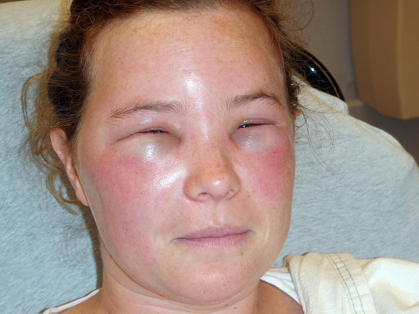 Une réaction allergique au Botox