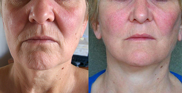 Grumbu korekcijas piemērs sejas apakšējā trešdaļā, izmantojot Botox.