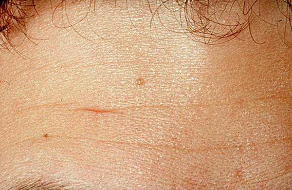 A foto mostra uma cicatriz na testa de um homem a ser corrigido.