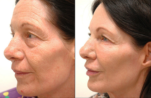 The procedure allows you to fight even with deep wrinkles on the face.