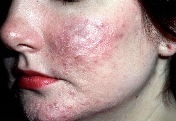 Botox n'est pas recommandé pour l'acné.