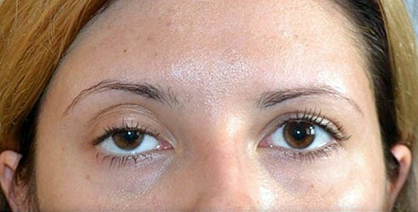 Botoxin jälkeen ylemmän silmäluomen osittainen ptoosi