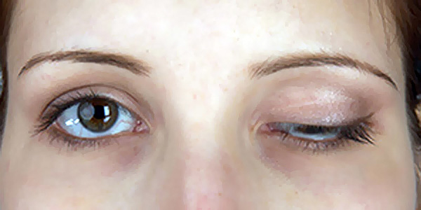 Komplett prolaps av ögonlocket efter botulinumterapi