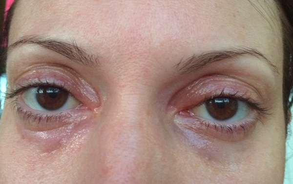 Botulinum toksini enjeksiyonundan sonra göz kapaklarının şişmesi