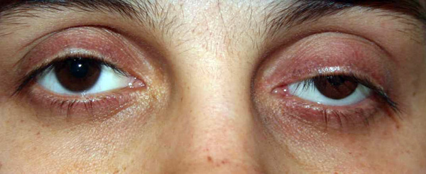 Blepharoptosis van beide oogleden