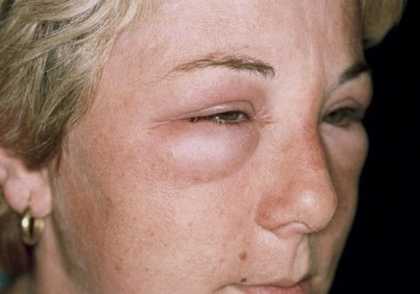 Swelling of the face after Botox injections