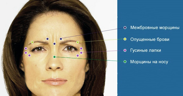 Botulinum toxin injection points for correcting certain wrinkles