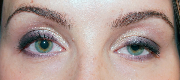 Botox Unter Den Augen Foto Vor Und Nach Injektionen Sind Falten Verschwunden