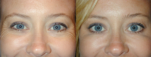 Correction of wrinkles in the corners of the eyes