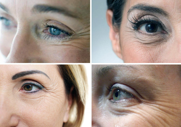 Dynamic wrinkles in the corners of the eyes - 