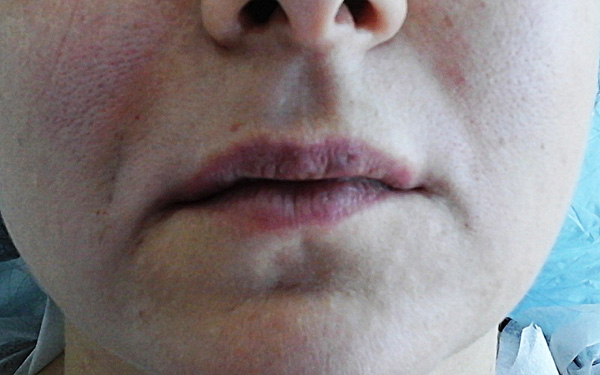 Omission du coin de la bouche après l'introduction du Botox