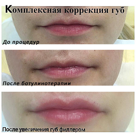 Monimutkainen huulten korjaus (Botox ja täyteaineet)