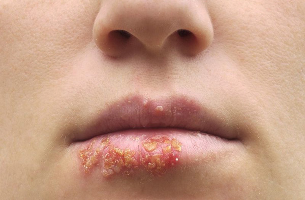 Aktyvavus herpesui ant lūpų, švirkščiamos raukšlės šioje srityje korekcijos neatliekamos