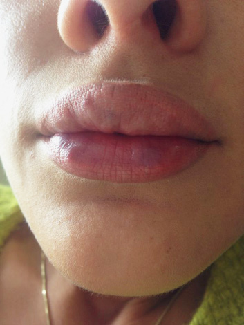 Појава печата на уснама након уношења пунила