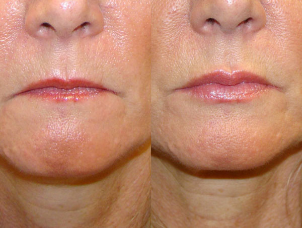 Το άνω χείλος ενισχυμένο με Botox οφείλεται σε χαλάρωση των μυών