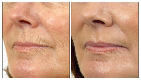 Botulinum to reduce wrinkles around the mouth