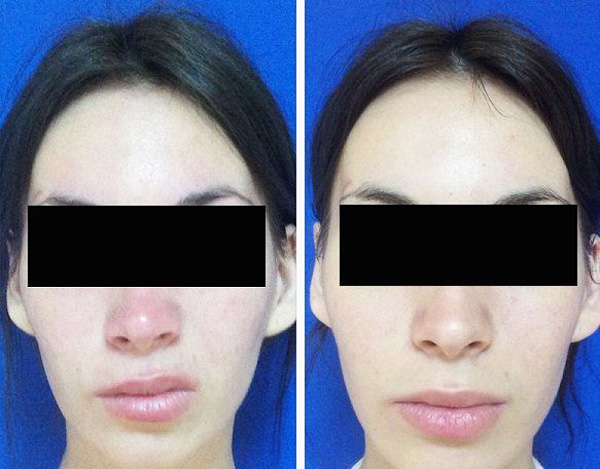 Smoothing lip asymmetry defect with Botox