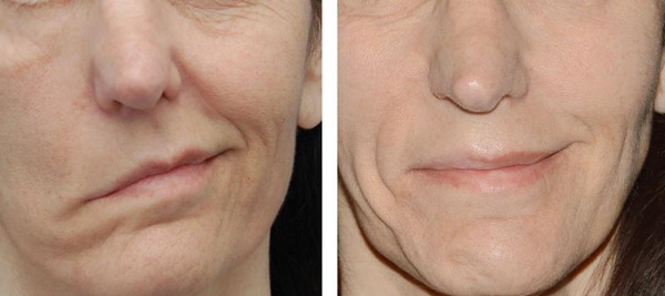 Botox-injektiot suun pyöreään lihakseen auttavat poistamaan vääristymiä