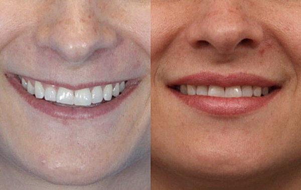Az ajkak természetes térfogatának visszatérése a felső ajak izmainak Botox általi gyengülése miatt