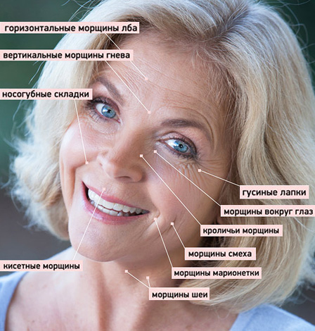 Uttrykk rynker som kan korrigeres av Botox