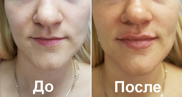 Lippenvergrößerung mit Füllstoffen (vorher und nachher)
