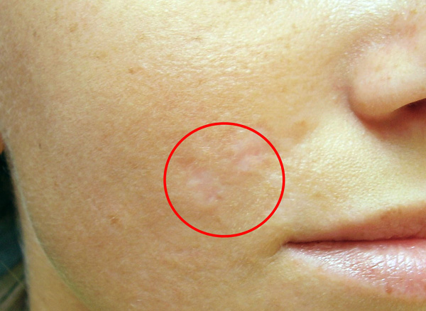 Formation de cicatrice aux sites d’administration de Botox chez les patients prédisposés aux cicatrices chéloïdes