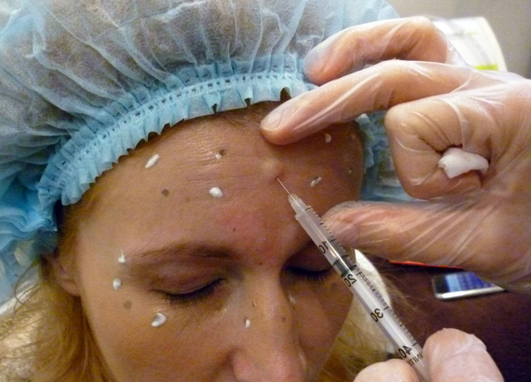 Bilangan unit Botox dikira secara individu