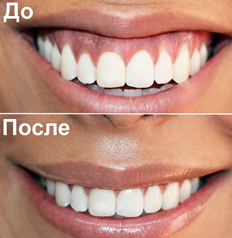 Botox correction du sourire gingival