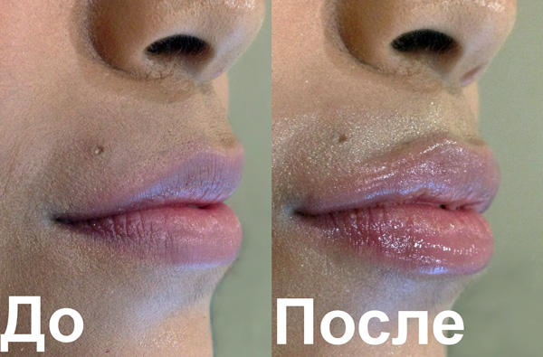 Ağızdaki dairesel kastaki Botox, dudakları daha belirgin hale getirir