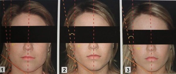 Corrección del contorno facial de Botox