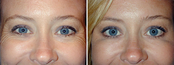 Élimination des rides dans le contour des yeux (état avant et après la procédure)