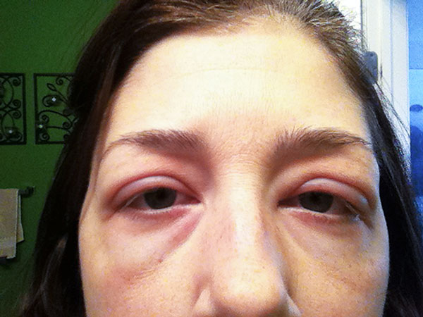 Gonflement des yeux après un traitement au botulinum