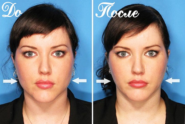 Correção de contorno facial de Botox