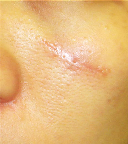 Keloïde huid met littekens