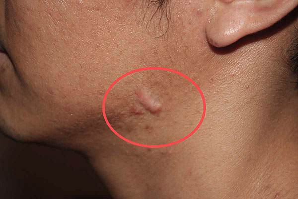 S'il y a une tendance à la cicatrisation chéloïde, il est préférable de refuser la thérapie botulique.
