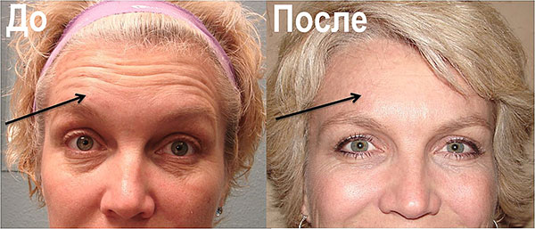 Botox contre les rides du front (avant et après la procédure)